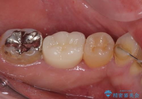 銀歯の入った歯が欠けた 奥歯のオールセラミッククラウン補綴治療の治療後