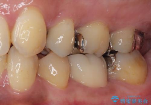 銀歯の入った歯が欠けた　奥歯のオールセラミッククラウン補綴治療の治療後
