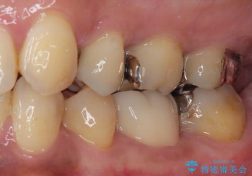銀歯の入った歯が欠けた 奥歯のオールセラミッククラウン補綴治療の治療後