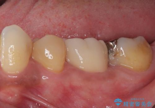銀歯の入った歯が欠けた　奥歯のオールセラミッククラウン補綴治療の治療後