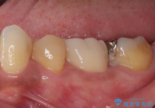 銀歯の入った歯が欠けた 奥歯のオールセラミッククラウン補綴治療の治療後