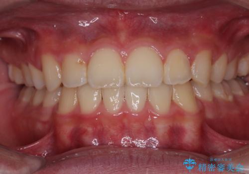 突出した口元 ワイヤー装置で横顔の印象を改善の症例 治療後