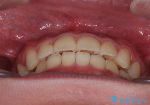 突出した口元 ワイヤー装置で横顔の印象を改善の治療後