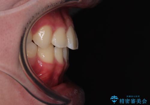 突出した口元 ワイヤー装置で横顔の印象を改善の治療後