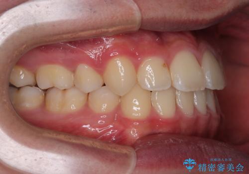 突出した口元 ワイヤー装置で横顔の印象を改善の治療後