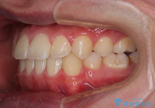 突出した口元 ワイヤー装置で横顔の印象を改善の治療後