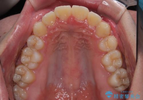 突出した口元 ワイヤー装置で横顔の印象を改善の治療後