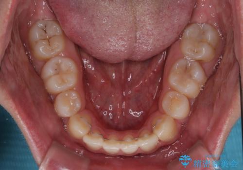 突出した口元 ワイヤー装置で横顔の印象を改善の治療後