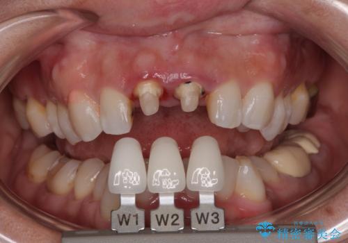 前歯の黄色味が気になる オールセラミッククラウン(スペシャル)の治療中