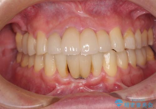 放置した歯列 矯正治療とインプラント治療で劇的に改善の症例 治療後