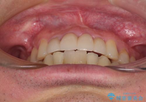 放置した歯列 矯正治療とインプラント治療で劇的に改善の治療後