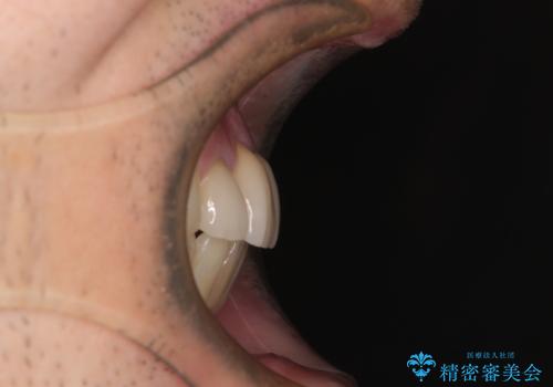 放置した歯列 矯正治療とインプラント治療で劇的に改善の治療後