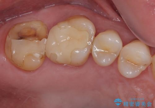食事中に歯が欠けたので治したい。オールセラミッククラウンによる補綴の治療前