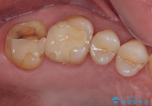 食事中に歯が欠けたので治したい。オールセラミッククラウンによる補綴の症例 治療前