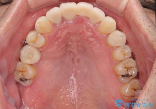 放置した歯列 矯正治療とインプラント治療で劇的に改善の治療後