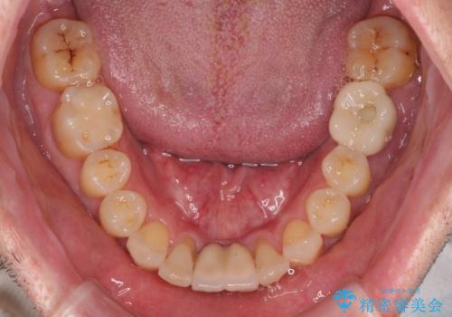 放置した歯列 矯正治療とインプラント治療で劇的に改善の治療後