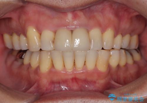八重歯と突出感を改善 ワイヤー装置での矯正治療