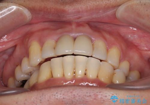 八重歯と突出感を改善 ワイヤー装置での矯正治療の治療後