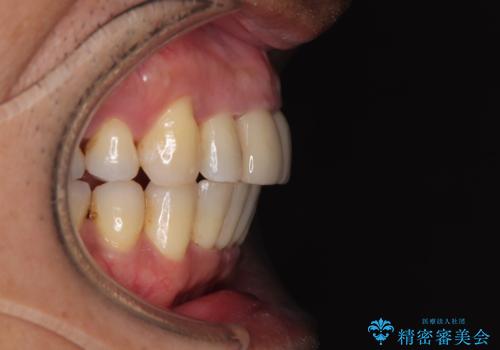 八重歯と突出感を改善 ワイヤー装置での矯正治療の治療後