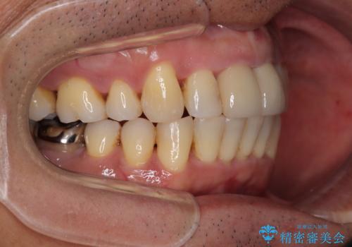 八重歯と突出感を改善 ワイヤー装置での矯正治療の治療後