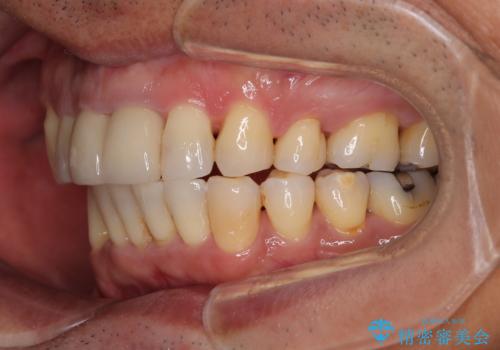 八重歯と突出感を改善 ワイヤー装置での矯正治療の治療後