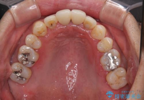 八重歯と突出感を改善 ワイヤー装置での矯正治療の治療後