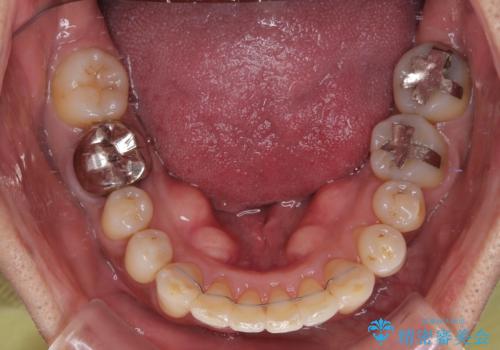 八重歯と突出感を改善　ワイヤー装置での矯正治療の治療後