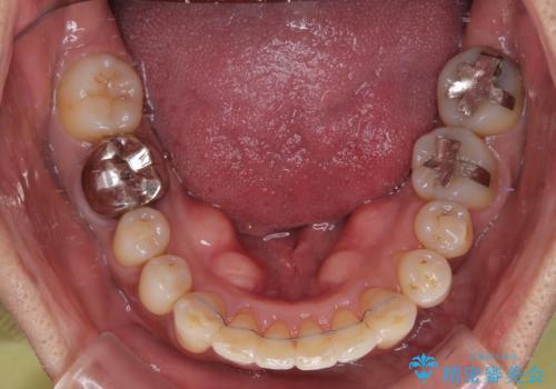 八重歯と突出感を改善 ワイヤー装置での矯正治療の治療後