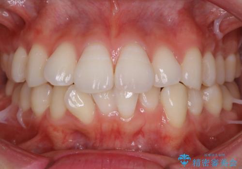 裏側装置で目立たず矯正!の症例 治療前