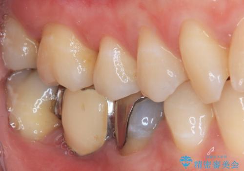 銀歯をやり替えたい。インプラントとセラミックによる治療の治療前