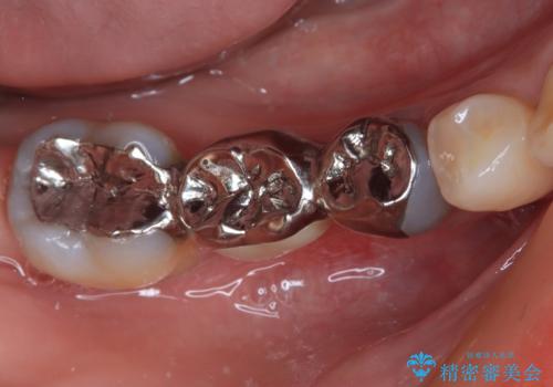 銀歯をやり替えたい。インプラントとセラミックによる治療の症例 治療前