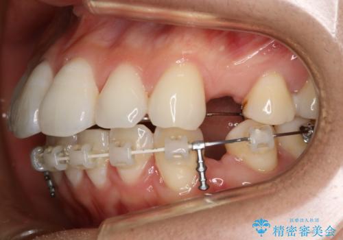 裏側装置で目立たず矯正!の治療中