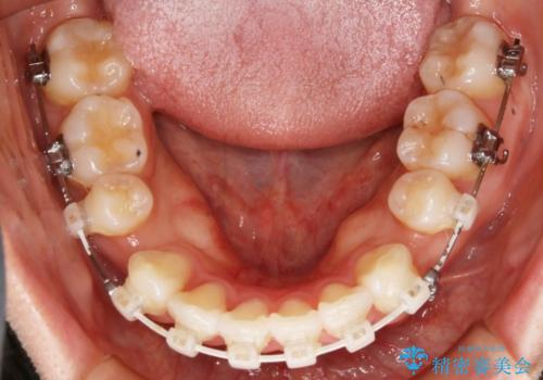 裏側装置で目立たず矯正!の治療中