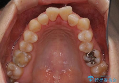 インビザラインによる前歯のガタガタ改善治療の治療前