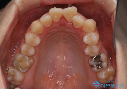 インビザラインによる前歯のガタガタ改善治療
