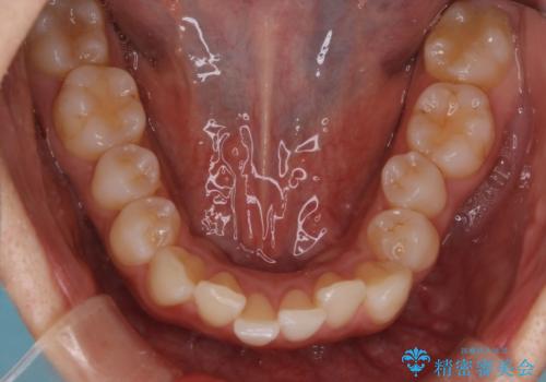 インビザラインによる前歯のガタガタ改善治療の治療前