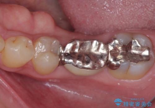 外れやすい銀歯をどうにかしたい。フルジルコニアブリッジによる補綴の症例 治療前