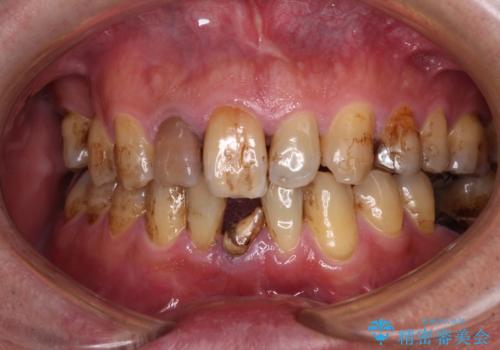 放置した歯列 矯正治療とインプラント治療で劇的に改善の症例 治療前