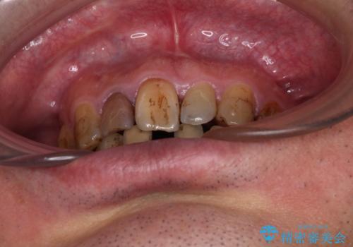 放置した歯列 矯正治療とインプラント治療で劇的に改善の治療前