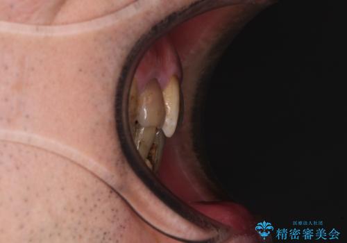 放置した歯列 矯正治療とインプラント治療で劇的に改善の治療前