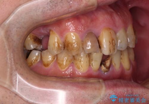 放置した歯列 矯正治療とインプラント治療で劇的に改善の治療前