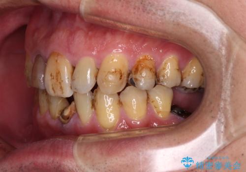 放置した歯列 矯正治療とインプラント治療で劇的に改善の治療前