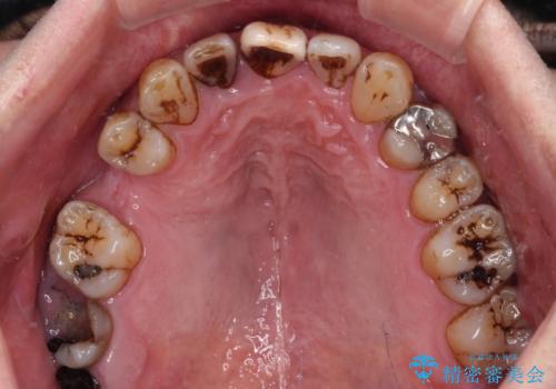 放置した歯列 矯正治療とインプラント治療で劇的に改善の治療前