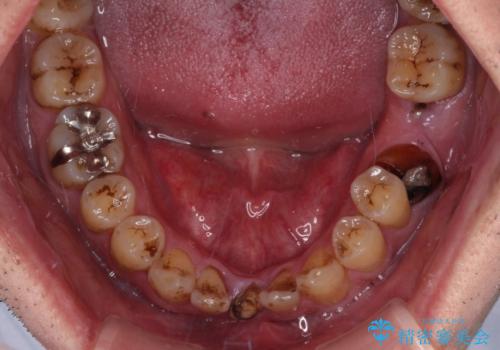 放置した歯列　矯正治療とインプラント治療で劇的に改善の治療前