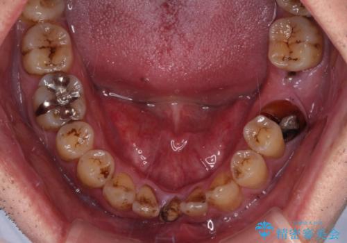 放置した歯列 矯正治療とインプラント治療で劇的に改善の治療前