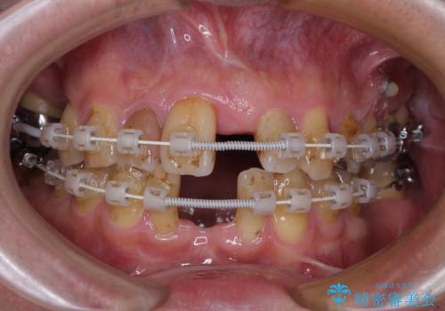 放置した歯列　矯正治療とインプラント治療で劇的に改善の治療中