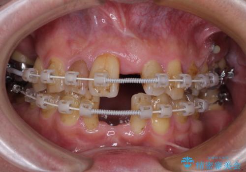 放置した歯列 矯正治療とインプラント治療で劇的に改善の治療中