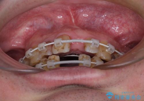 放置した歯列 矯正治療とインプラント治療で劇的に改善の治療中