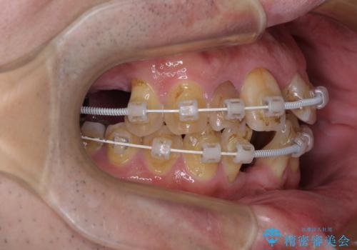 放置した歯列　矯正治療とインプラント治療で劇的に改善の治療中