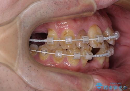 放置した歯列 矯正治療とインプラント治療で劇的に改善の治療中